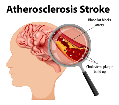 Atherosclerosis and Stroke